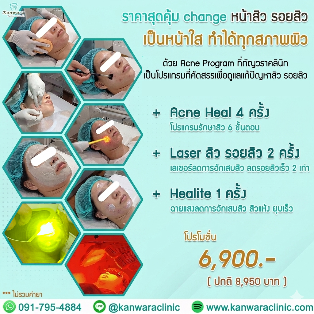 รักษาสิว วัยรุ่น ไม่แพง หายเร็ว 6900