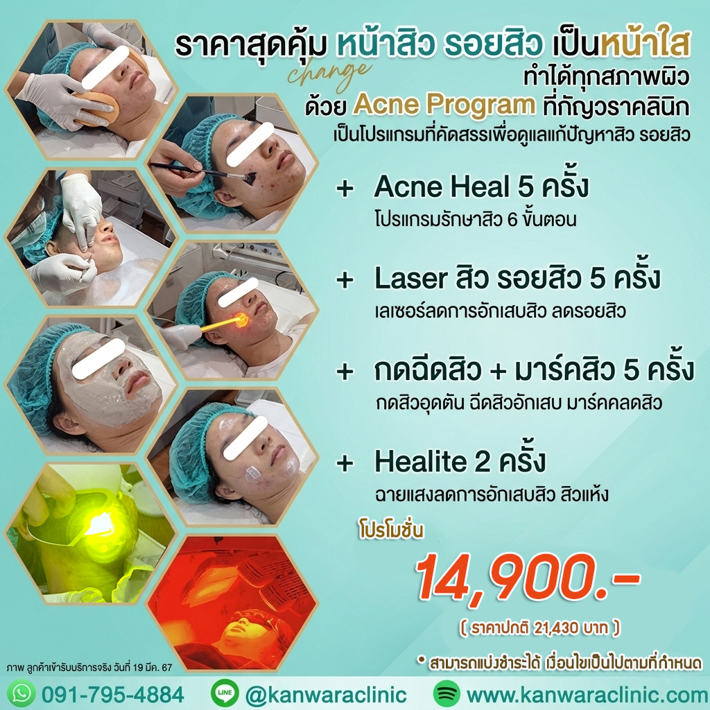 รักษาสิวหายขาด ราคา 14900